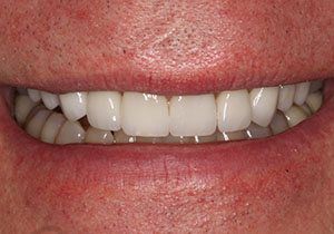 actual patient #1 restored smile through veneers