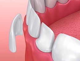 Animated cosmetic dentist veneer placement