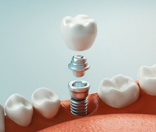 dental implant being placed in the lower jaw