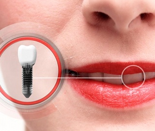 close-up of a woman smiling with a dental implant