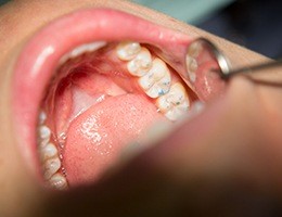 Closeup of teeth during tooth colored filling placement