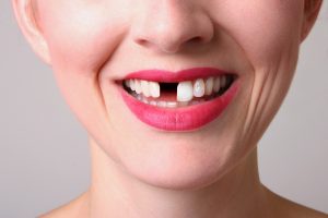 Missing Tooth