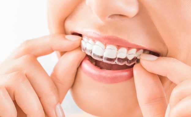 Invisalign tray being placed on teeth.