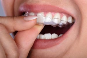 Close-up of teeth with clear aligner